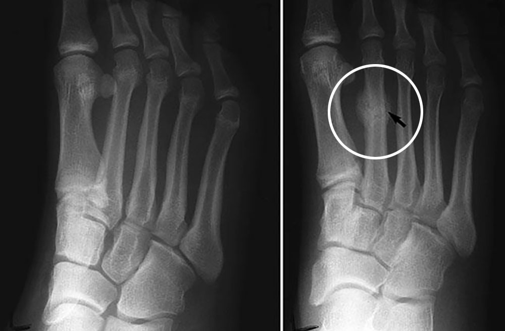 足の骨折の治療法の選択肢